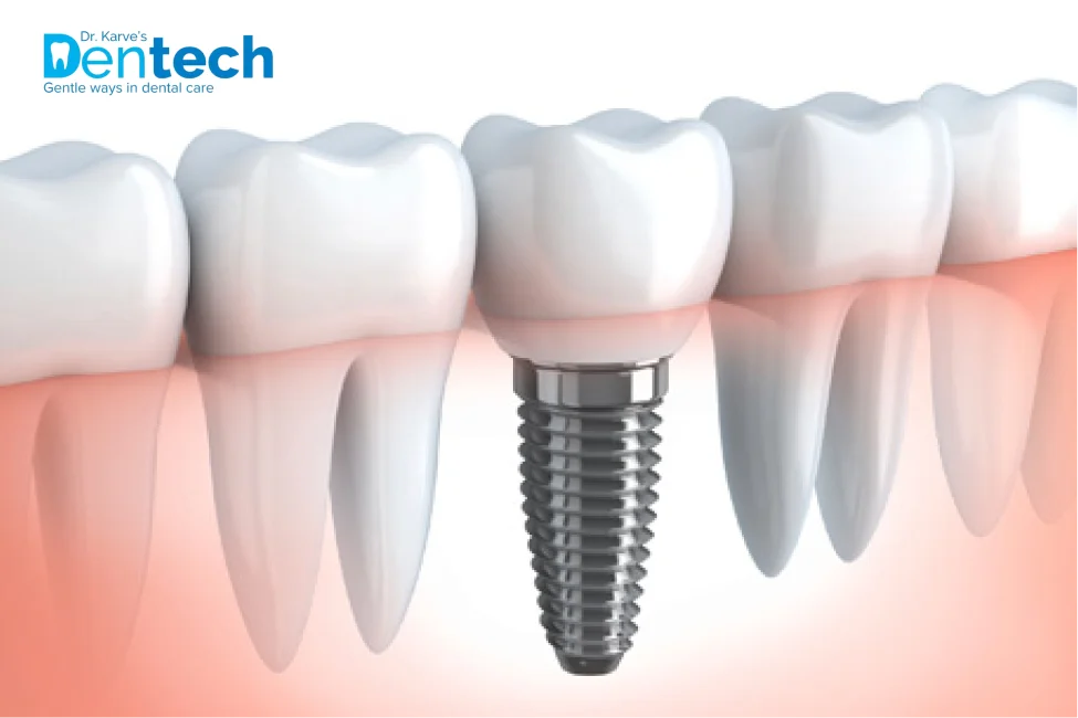 Dental Implants - Dr. Karve's Dentech